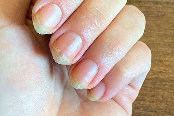 Vos ongles sont abîmés, mous, cassants, striés ou se dédoublent ?