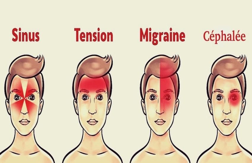 Comment se débarrasser d’un mal de tête sans médicament